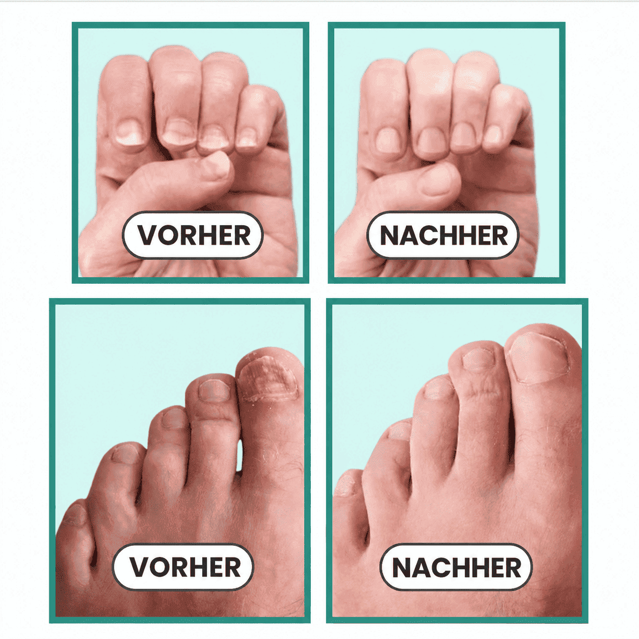 OrthoVita™ – Nagelpilz Lichttherapie-Gerät